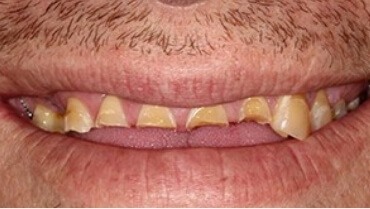Smile with severely decayed and damaged top front teeth