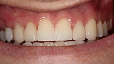 Beautiful smile after cosmetic dentistry