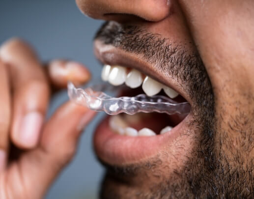 Dental patient placing Invisalign clear aligner